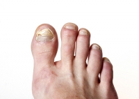 Pesky, Persistent Toenail Fungal Infections