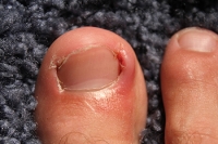 Reasons an Ingrown Toenail May Develop