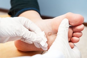 Plantar Wart Growth
