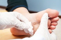 Plantar Wart Growth