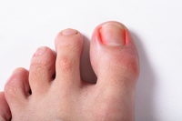 Babies Can Get Ingrown Toenails